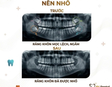 Răng khôn nên nhổ hay giữ lại? Giải đáp chi tiết từ bác sĩ Nha Khoa SV