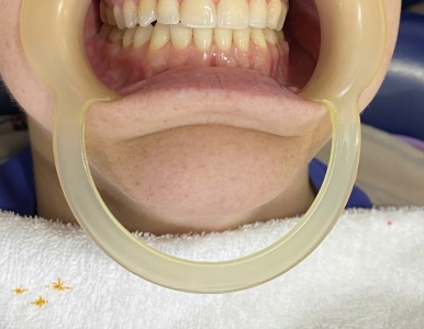 Dán Sứ Veneer Là Gì? Ưu Điểm, Quy Trình Và Những Điều Cần Biết Trước Khi Thực Hiện NHA KHOA SV 