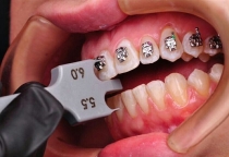 Niềng răng thẩm mỹ 