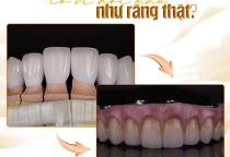 Răng sứ có bị đổi màu như răng thật không? Giải đáp từ bác sĩ nha khoa SV 
