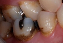 Thức Ăn Luôn Mắc Vào Một Kẽ Răng: Đừng Bỏ Qua Dấu Hiệu Này