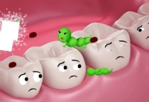 Sâu răng – Sát thủ âm thầm nhưng thật đáng sợ