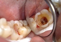 Răng Sâu Bị Bể Có Trám Được Không? Khi Nào Cần Chữa Tủy?