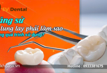 Răng sứ bị lung lay phải làm sao? Nguyên nhân – cách xử lý – phòng tránh hiệu quả tại Nha Khoa SV 
