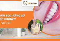 17 tuổi bọc răng sứ được không? Bác sĩ Nha Khoa SV giải đáp chi tiết