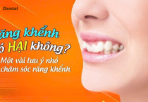 Răng khểnh có hại không? Những lưu ý quan trọng khi chăm sóc răng khểnh – Nha Khoa SV phân tích chi tiết
