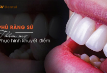 Dán sứ Veneer là gì? Ưu điểm, quy trình và độ bền thực tế tại Nha khoa SV