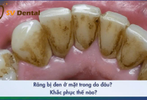 Răng Bị Đen Ở Mặt Trong: Nguyên Nhân, Tác Hại Và Cách Điều Trị Hiệu Quả Tại Nha Khoa SV
