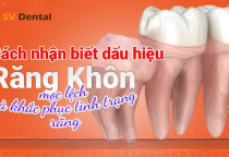 Cách nhận biết răng khôn mọc lệch & phương pháp khắc phục hiệu quả tại Nha Khoa SV