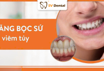 Răng Bọc Sứ Bị Viêm Tủy: Nguyên Nhân, Triệu Chứng Và Cách Điều Trị Hiệu Quả tại NHA KHOA SV 