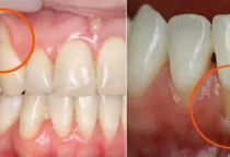 Điều trị tụt nướu (tụt lợi) – Viêm nha chu an toàn, hiệu quả tại Nha Khoa SV