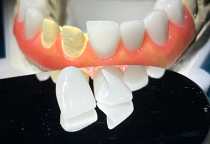 Bọc răng sứ thẩm mỹ