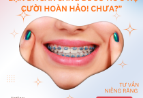 Niêng răng mắc cài trọn gói 33 triêu- gồm những gì ? 