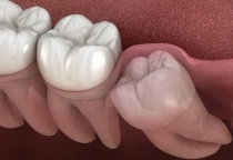 Cách giảm đau khi mọc răng khôn và chăm sóc sau tiểu phẫu tại NHA KHOA SV - QUẬN 3 