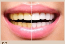 Tẩy trắng răng- Những điều cần lưu ý