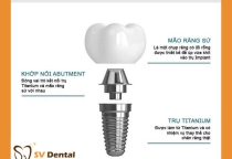 Cấy ghép Implant có đau không?
