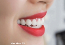 Dán răng sứ: Ưu điểm, nhược điểm và những điều cần biết trước khi thực hiện tại NHA KHOA SV 