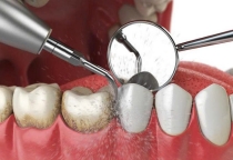 cạo vôi răng là gì ? quy trình và lợi ích của NHA KHOA SV  cạo vôi răng là gì ? quy trình và lợi ích của NHA KHOA SV