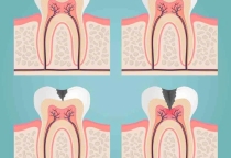 Răng  sâu không điều trị kịp dễ viêm tủy -hiểu đúng và điều trị kịp giữ răng thật tại NHA KHOA SV  Răng  sâu không điều trị kịp dễ viêm tủy -hiểu đúng và điều trị kịp giữ răng thật tại NHA KHOA SV