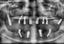 Cấy ghép implant all on 6 giải pháp bền vừng cho răng toàn hàm tại NHA KHOA SV, Phường Bàn Cờ, Tp. Hồ Chí Minh  Cấy ghép implant all on 6 giải pháp bền vừng cho răng toàn hàm tại NHA KHOA SV, Phường Bàn Cờ, Tp. Hồ Chí Minh