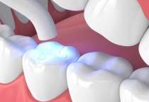 rám răng Inlay/Onlay sứ thẩm mỹ –  GIÁ DỊCH VỤ - 2.500.000- 6.000.000 / 1 ĐV RĂNG.tai NHA KHOA SV  XEM CHI TIẾT 