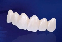 Bảng giá răng sứ Zirconia DMax/DDBIO – 5.000.000đ/răng | Nha Khoa SV