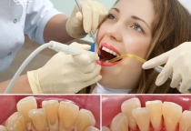 Điều Trị Viêm Nha Chu Hiệu Quả – Bảo Vệ Răng Chắc Khỏe Lâu Dài | Nha Khoa SV