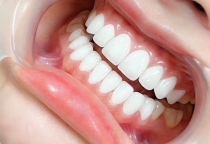 Dán Sứ Veneer Là Gì? Làm Răng Đẹp Tự Nhiên Tại Nha Khoa SV Quận 3