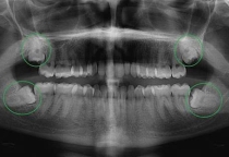 Răng khôn mọc lệch: Dấu hiệu, biến chứng và khi nào cần nhổ an toàn?
