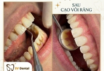 Bao lâu nên cạo vôi răng? Tần suất chuẩn giúp ngừa hôi miệng và viêm nướu