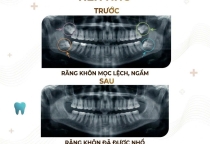 Răng khôn nên nhổ hay giữ lại? Giải đáp chi tiết từ bác sĩ Nha Khoa SV