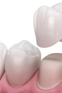 Khách hàng bọc răng sứ thẩm mỹ 