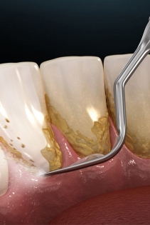 Dịch vụ cạo vôi răng tại Nha khoa SV quận 3
