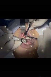 Cắm Implant tại Nha Khoa SV (SV Dental)