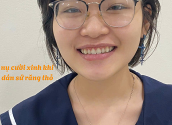 Diêu Nhi dán sứ răng thỏ 