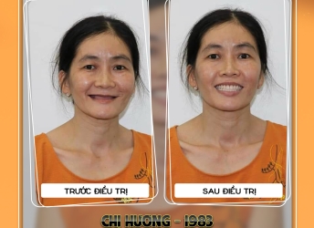 CHỊ HƯƠNG - RĂNG THÁO LẮP TOÀN HÀM 