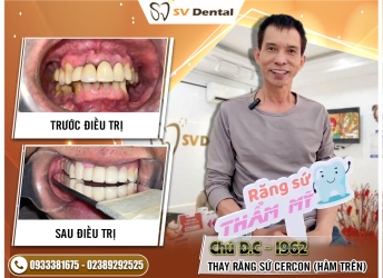 CHÚ D.C THAY RĂNG SỨ CERCON 