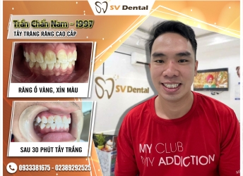 ANH TRẦN CHẤN NAM  - TẨY TRẮNG RĂNG 