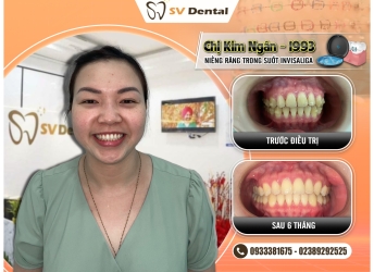 CHỊ KIM NGÂN NIỀNG RĂNG TRONG SUỐT INVISALIGA 