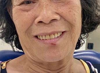 răng gia thao lap
