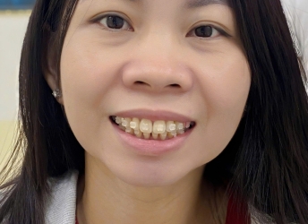 CHỊ THANH CHỌN NIỀNG RĂNG TẠI NHA KHOA SV 