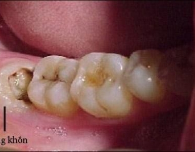 Răng khôn: Khi nào nên nhổ?