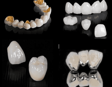 Các loại răng sứ thẩm mỹ phổ biến hiện nay: Nha khoa SV quận 3