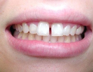 Trám răng thưa và những điều cần thiết: Nha khoa SV quận 3 