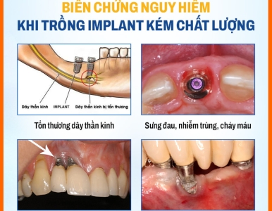 Biến Chứng Nguy Hiểm Khi Trồng Răng Implant Kém Chất Lượng – Cách Phòng Tránh