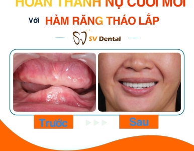 Hoàn Thành Nụ Cười Mới Với Hàm Răng Tháo Lắp Tại SV Dental