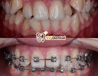 🦷 Niềng Răng Thẩm Mỹ – Giải Pháp Cho Nụ Cười Đẹp & Khớp Cắn Chuẩn