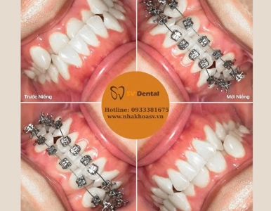 Niềng Răng TPHCM – Khắc Phục Răng Lệch Lạc, Lấy Lại Nụ Cười Chuẩn Đẹp Tại SV Dental Quận 3