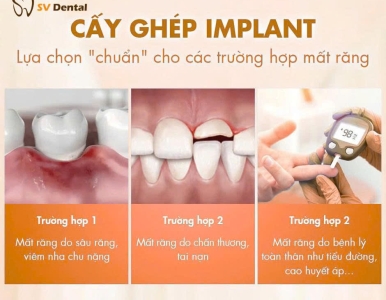 Cấy ghép Implant — Lựa chọn "chuẩn" cho các trường hợp mất răng