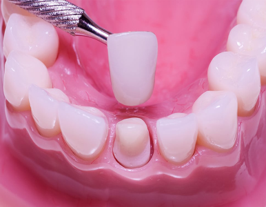 Bọc răng sứ là gì? Quy trình bọc răng sứ hiện nay 